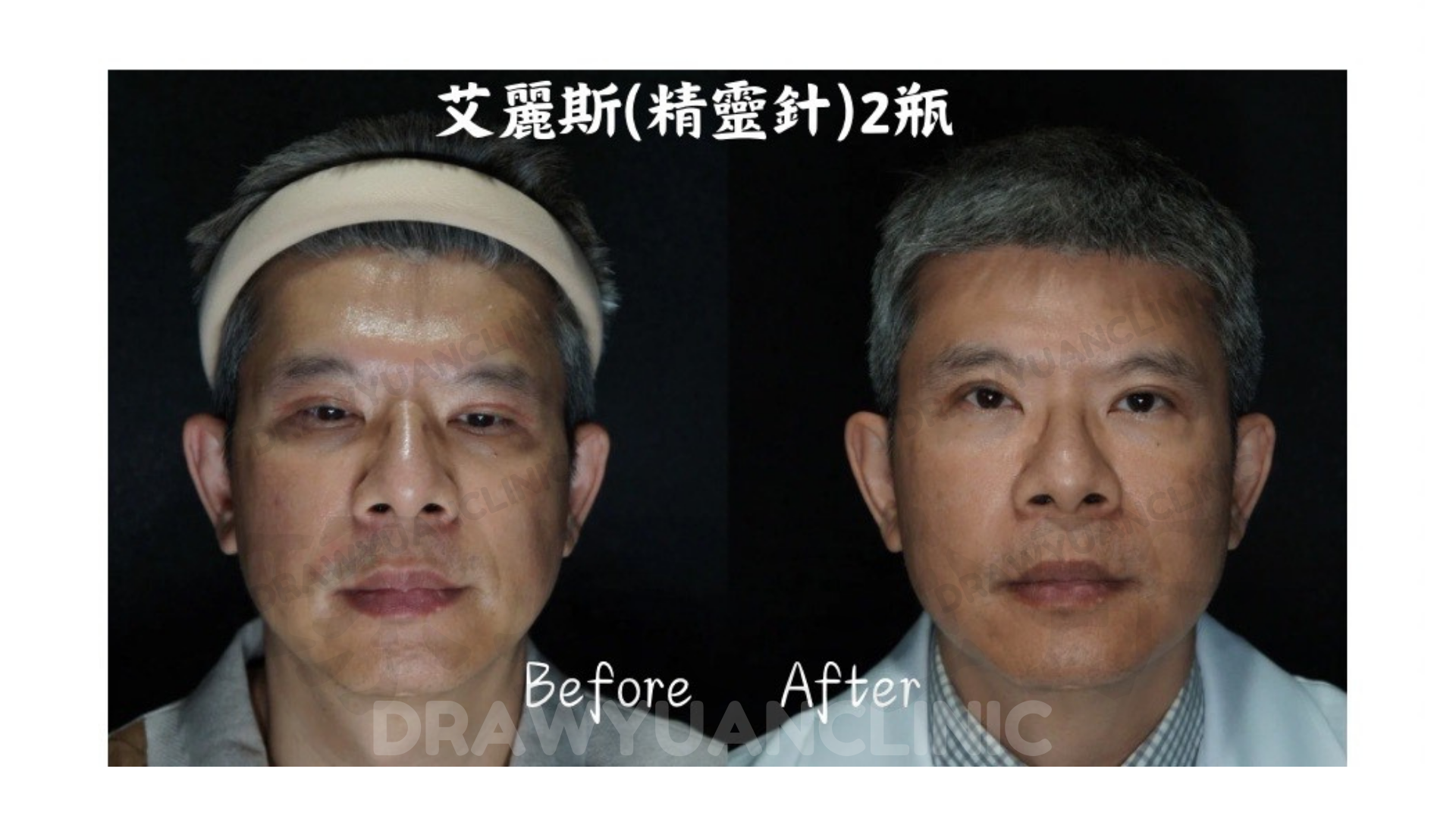 ------照片已簽屬肖像同意書 免責聲明 療程效果因人而異,圖片皆為該案例實際術後成效------