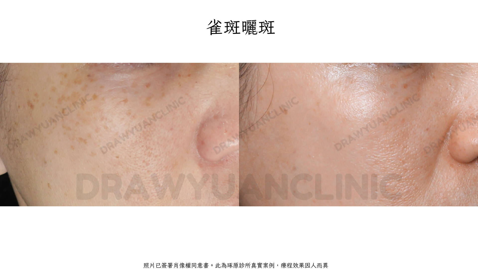 照片已簽署肖像權同意書。此為琢原診所真實案例,療程效果因人而異