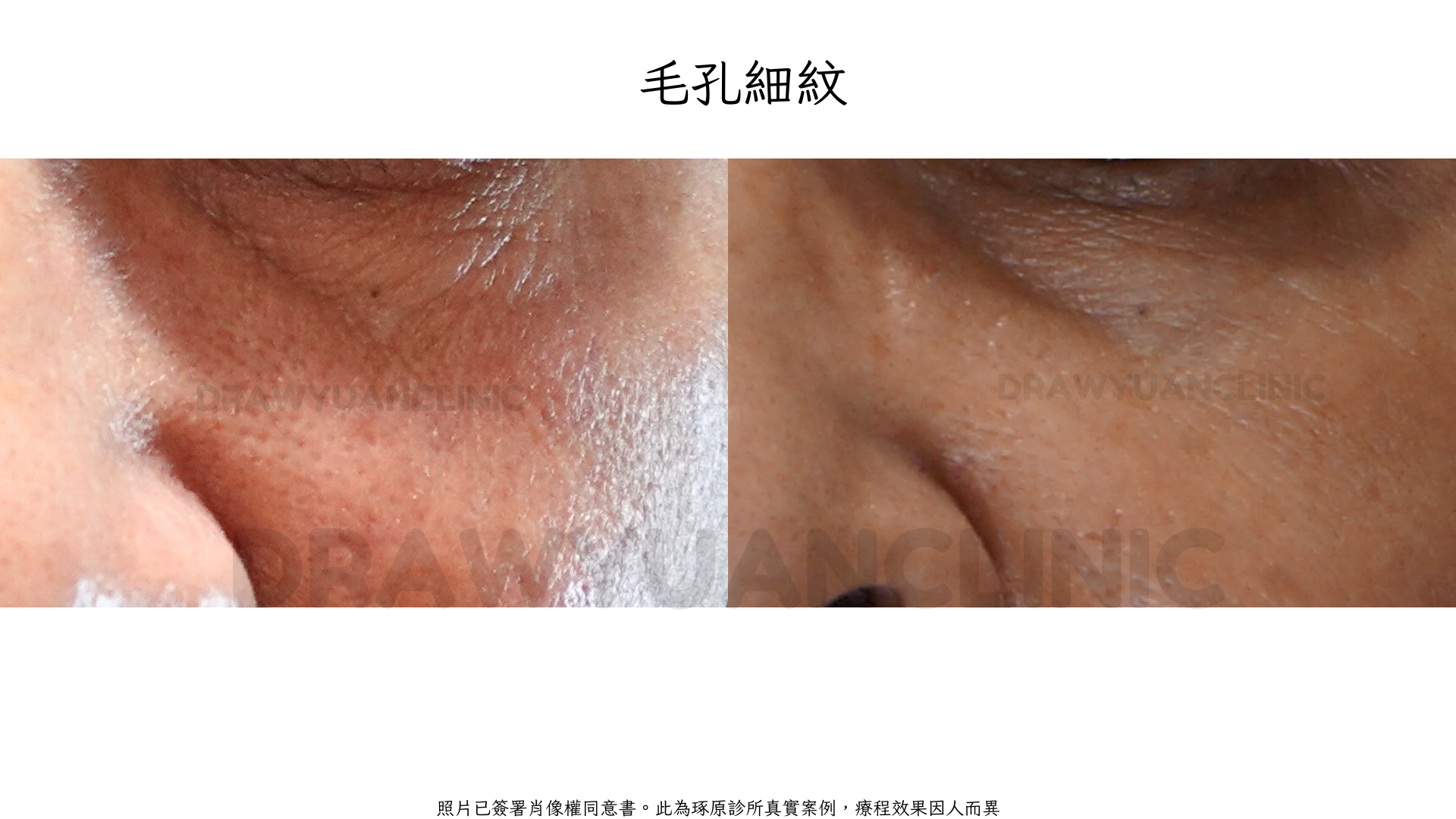 照片已簽署肖像權同意書。此為琢原診所真實案例,療程效果因人而異