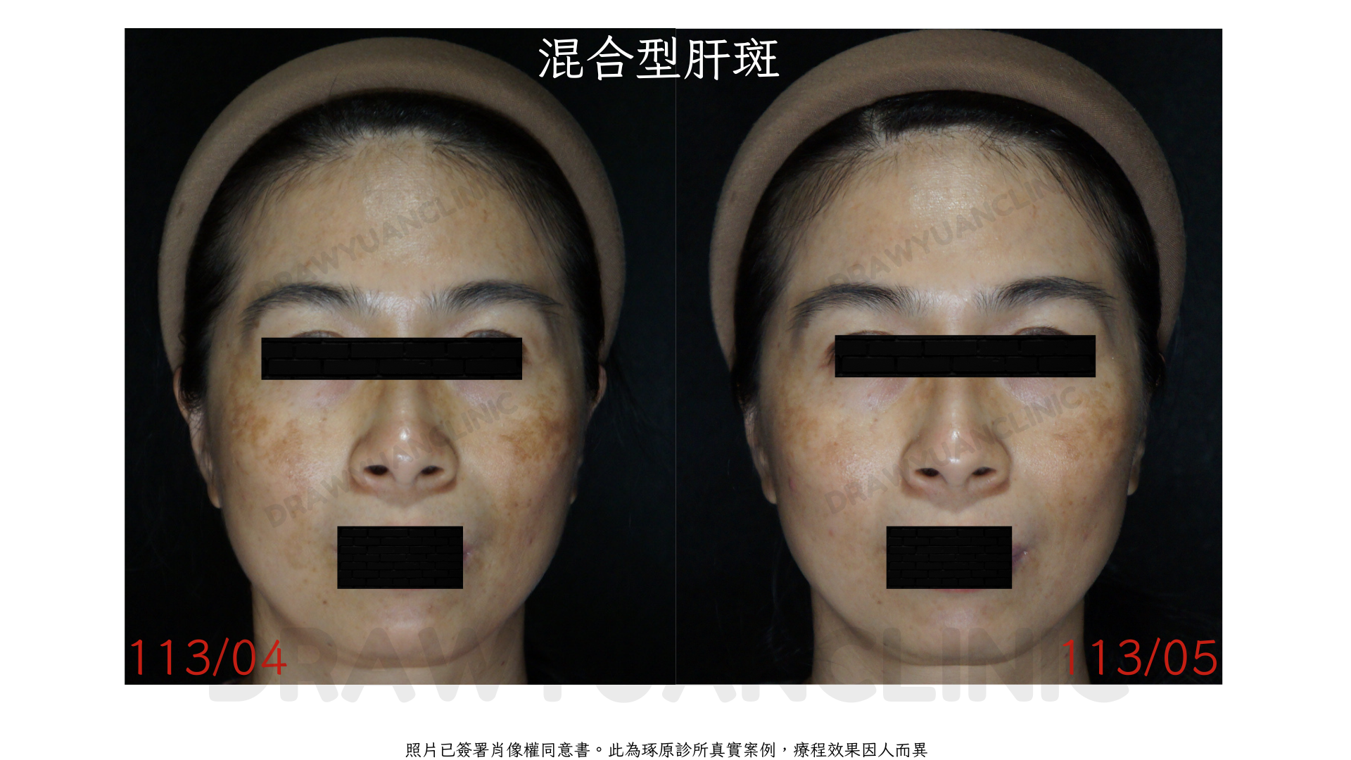 照片已簽署肖像權同意書。此為琢原診所真實案例,療程效果因人而異