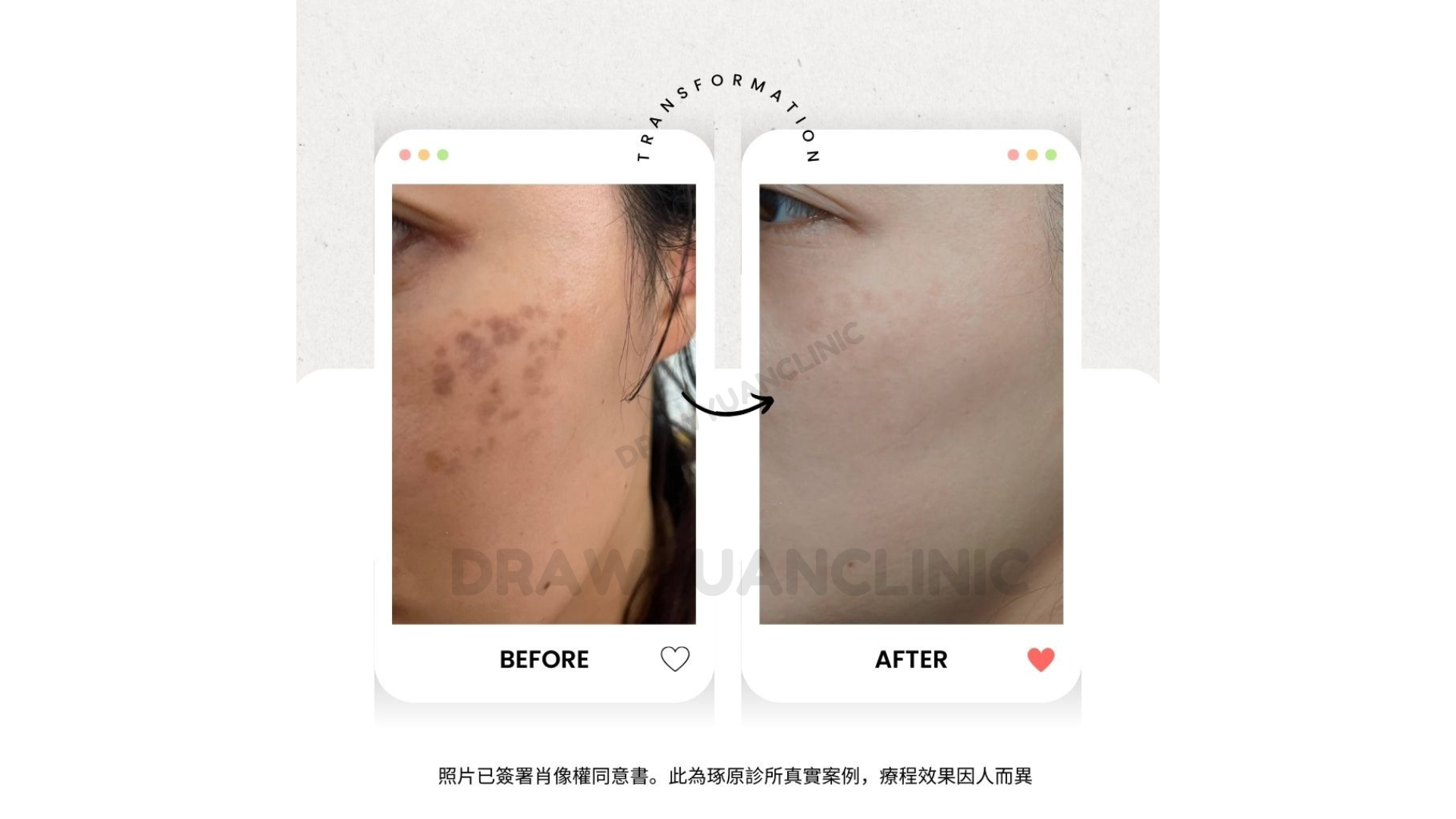 照片已簽署肖像權同意書。此為琢原診所真實案例,療程效果因人而異