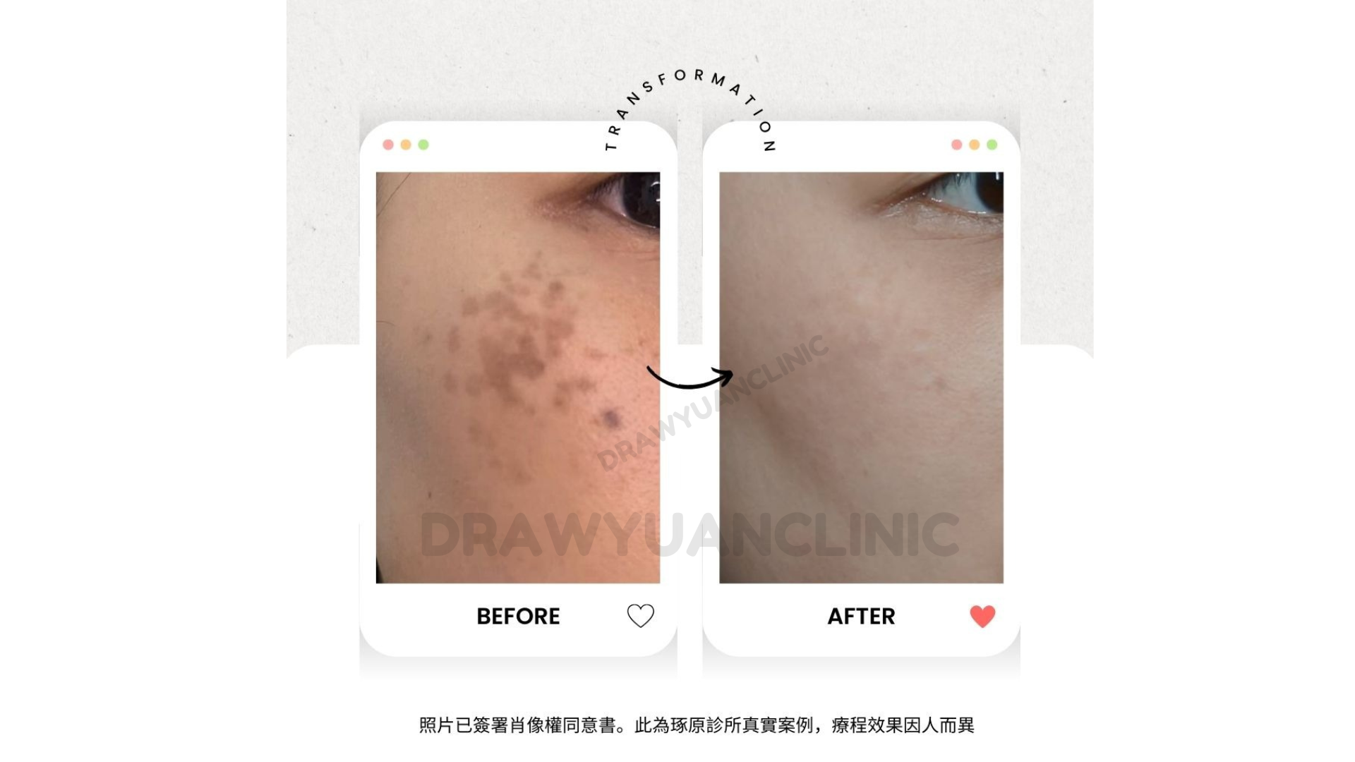 照片已簽署肖像權同意書。此為琢原診所真實案例,療程效果因人而異