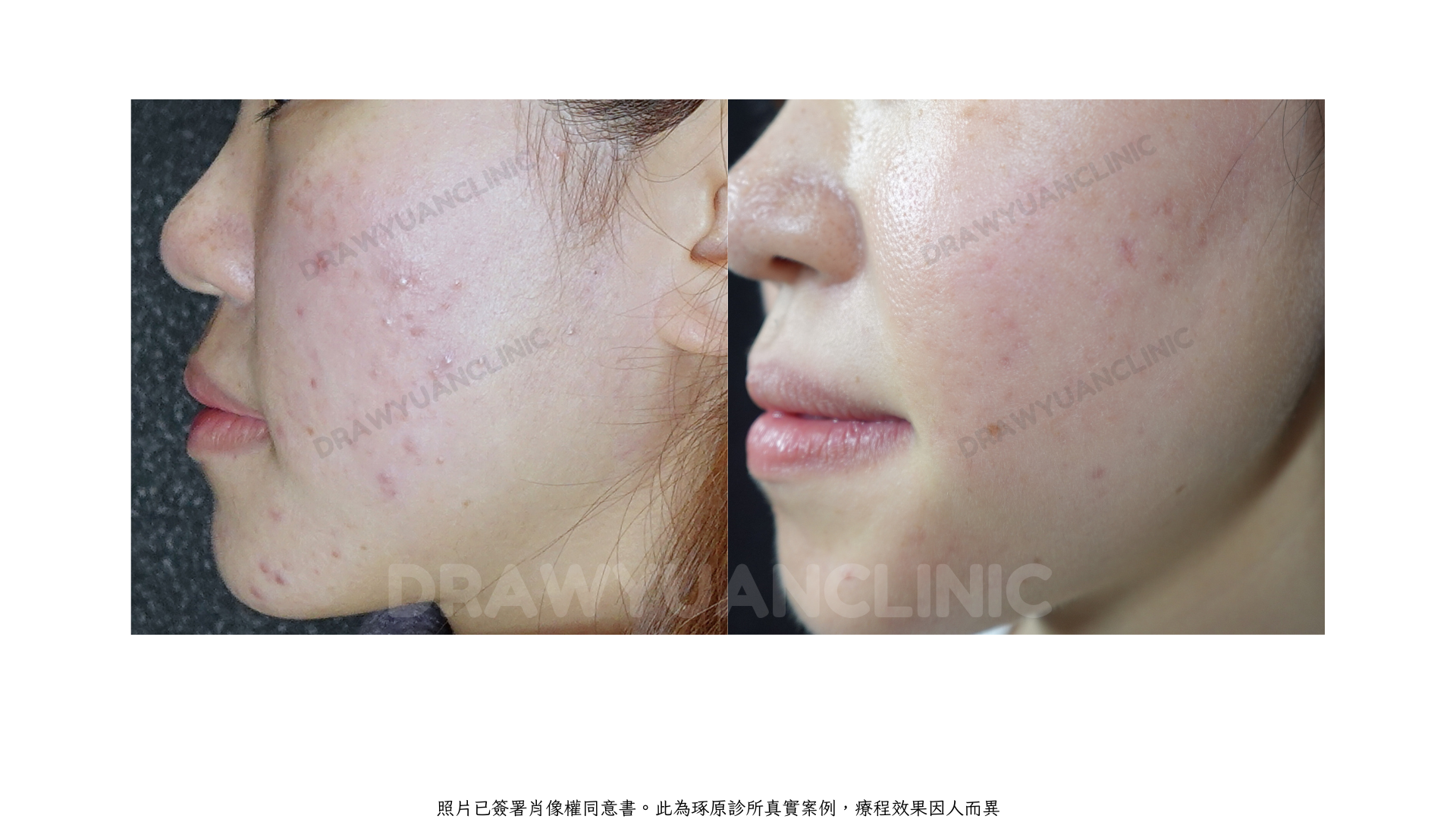 照片已簽署肖像權同意書。此為琢原診所真實案例，療程效果因人而異