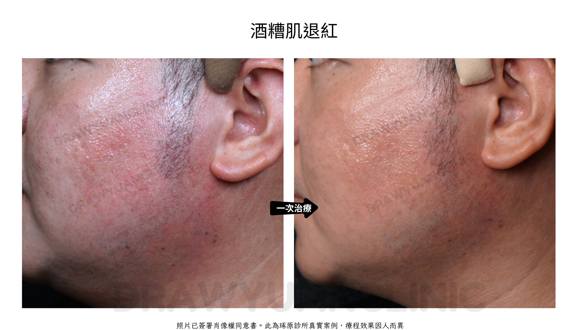 照片已簽署肖像權同意書。此為琢原診所真實案例,療程效果因人而異