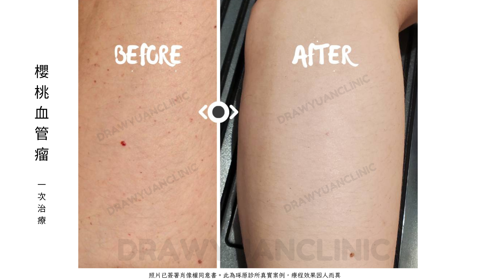 照片已簽署肖像權同意書。此為琢原診所真實案例,療程效果因人而異