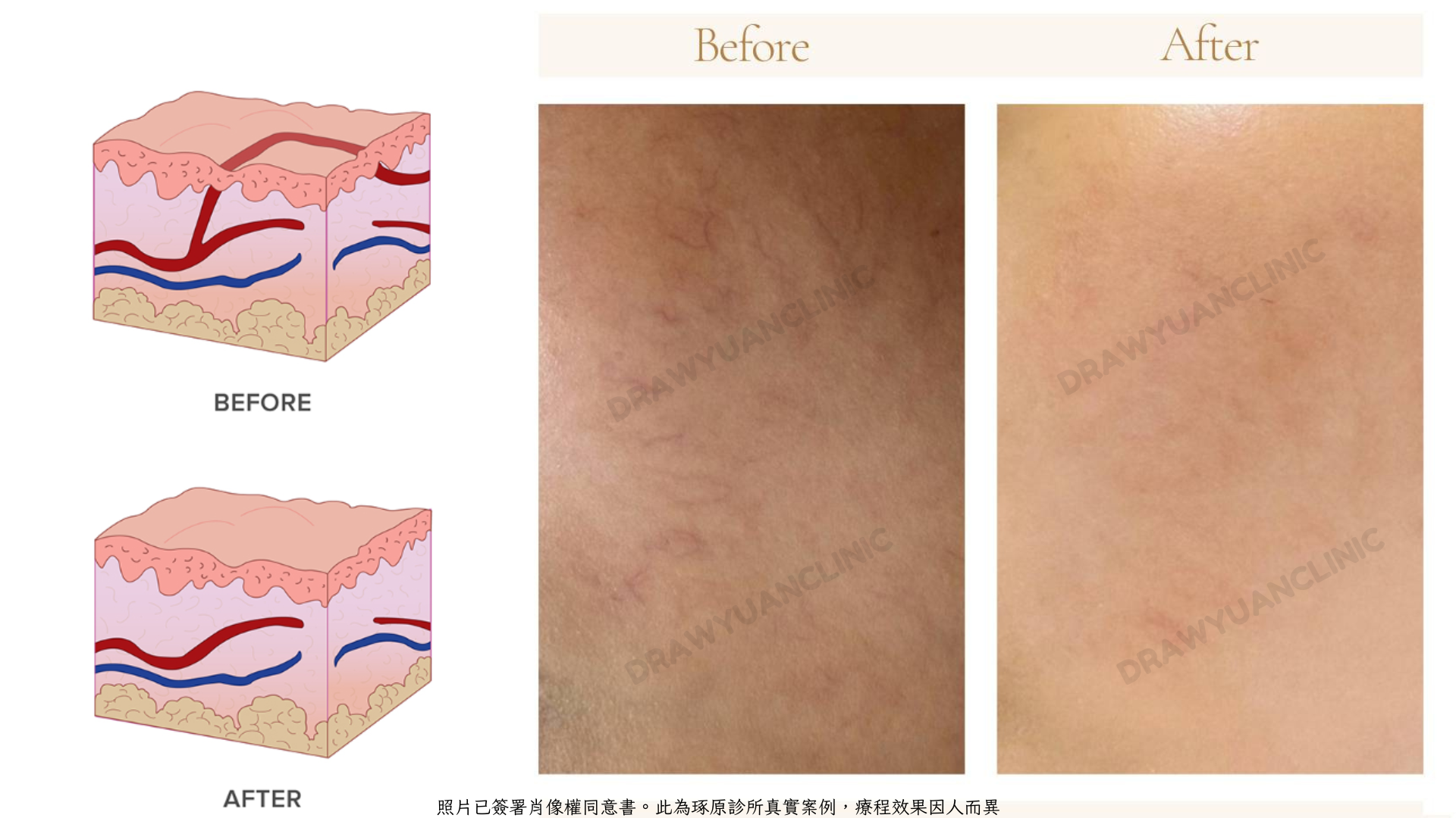 照片已簽署肖像權同意書。此為琢原診所真實案例,療程效果因人而異