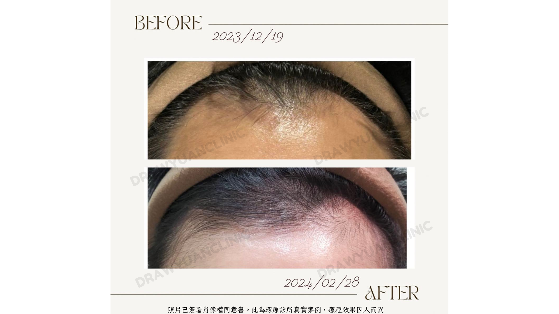 照片已簽署肖像權同意書。此為琢原診所真實案例,療程效果因人而異