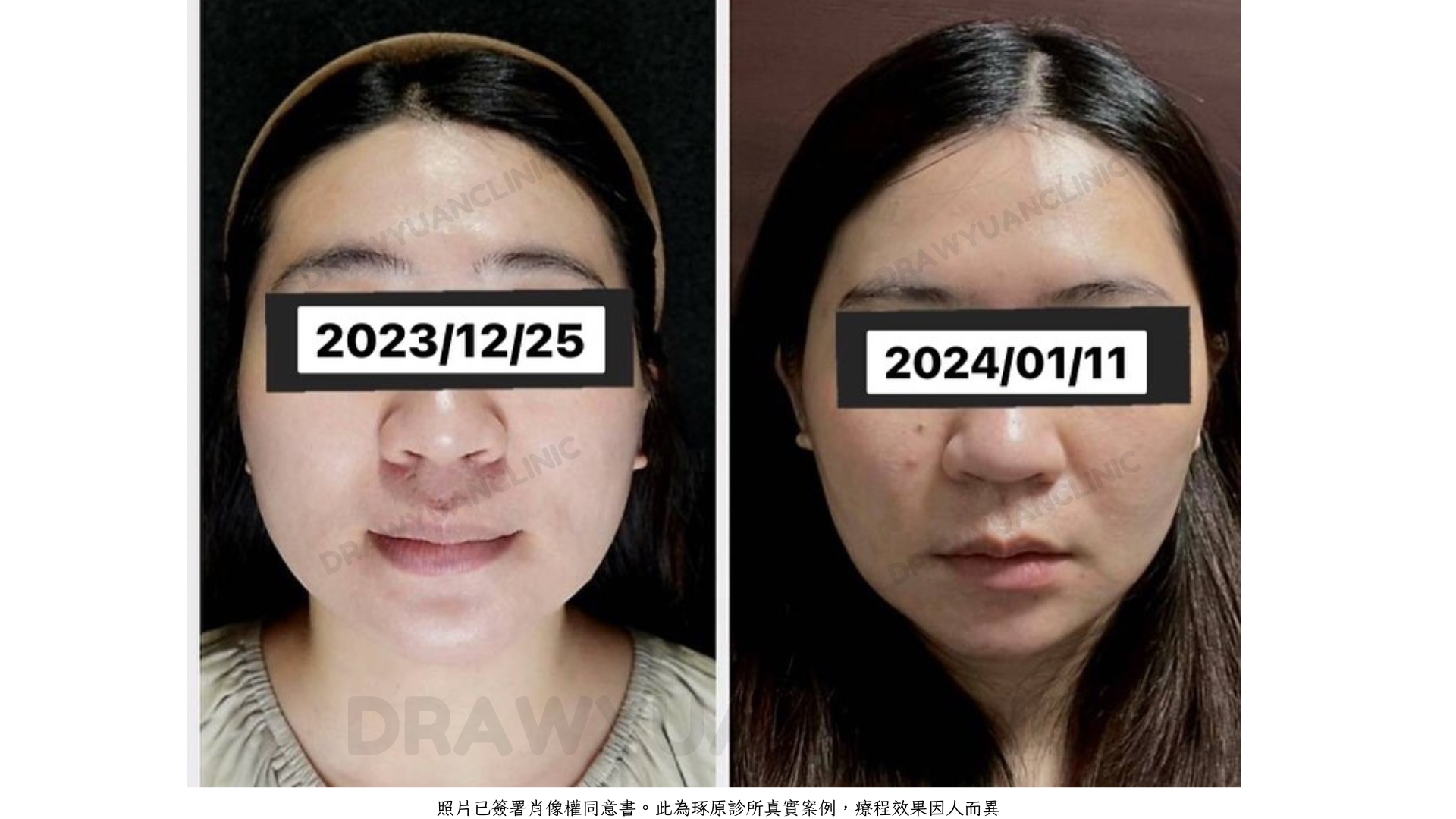 照片已簽署肖像權同意書。此為琢原診所真實案例,療程效果因人而異