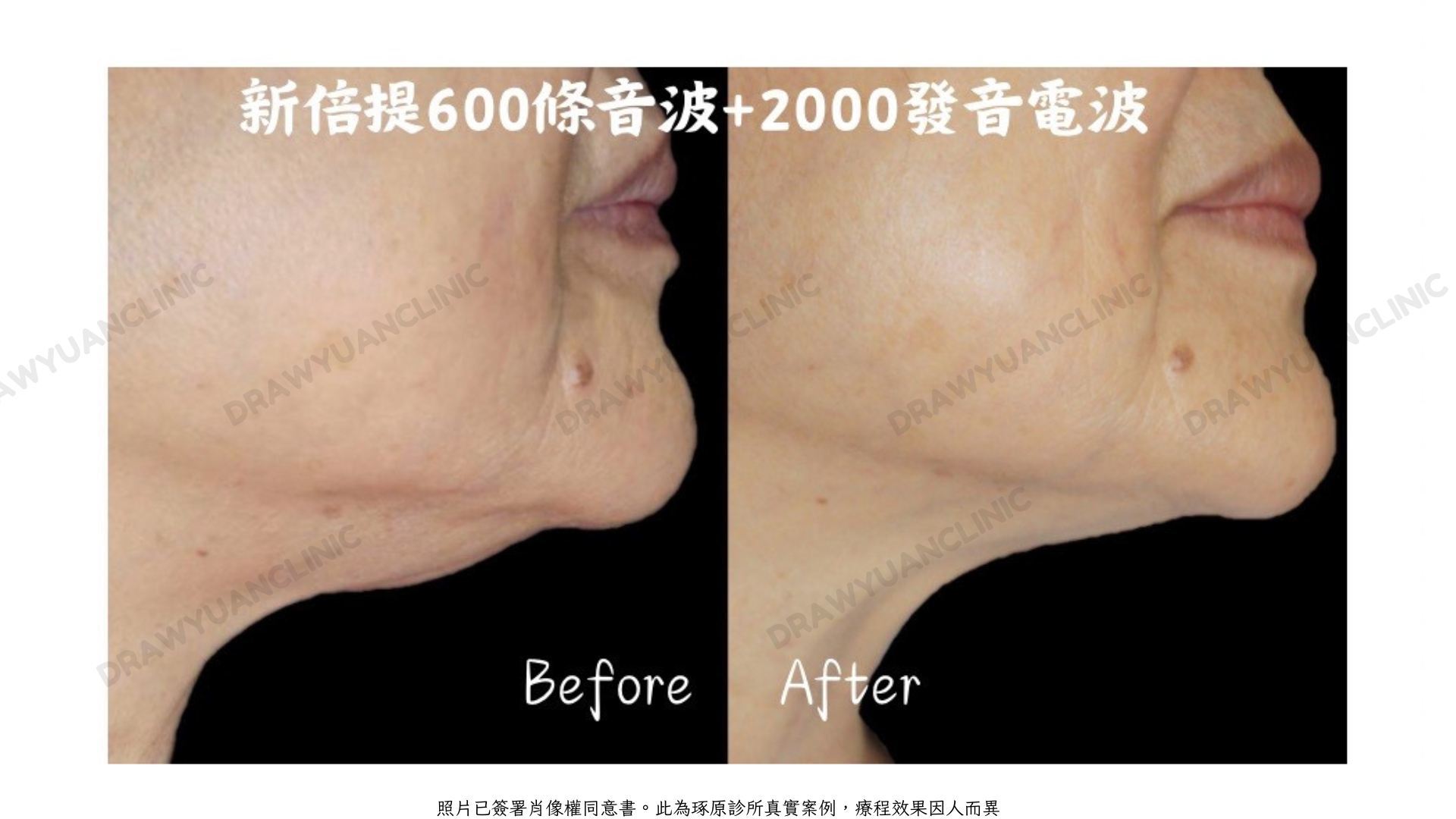 照片已簽署肖像權同意書。此為琢原診所真實案例,療程效果因人而異