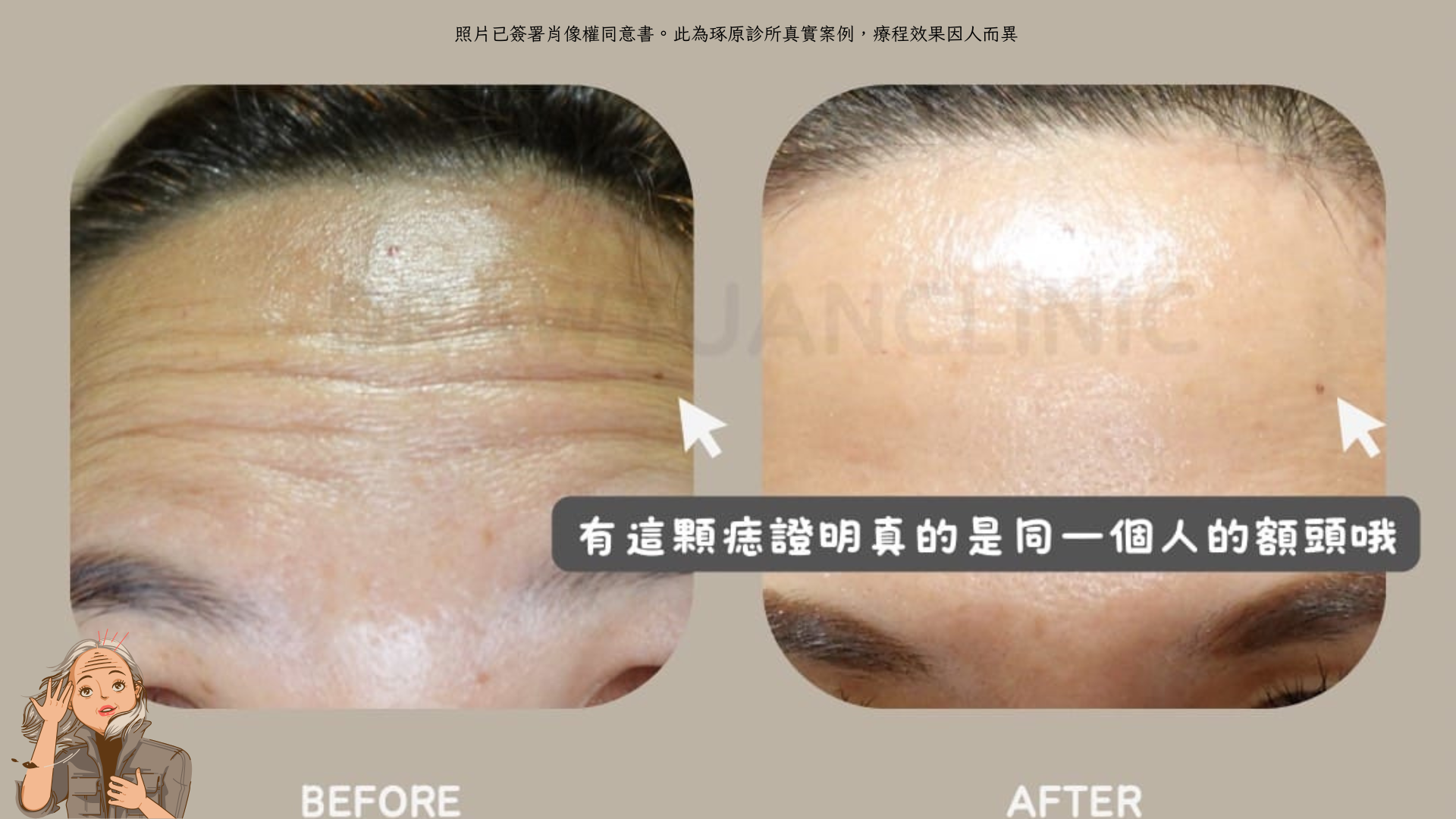 照片已簽署肖像權同意書。此為琢原診所真實案例，療程效果因人而異