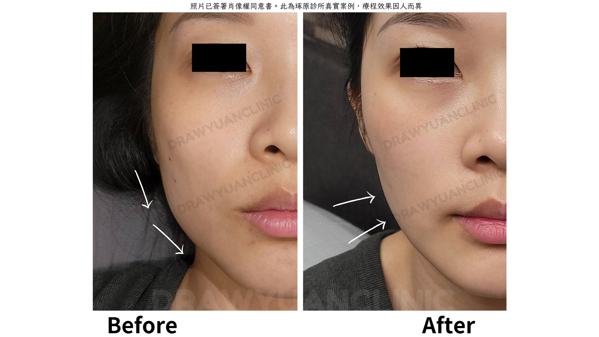 照片已簽署肖像權同意書。此為琢原診所真實案例，療程效果因人而異
