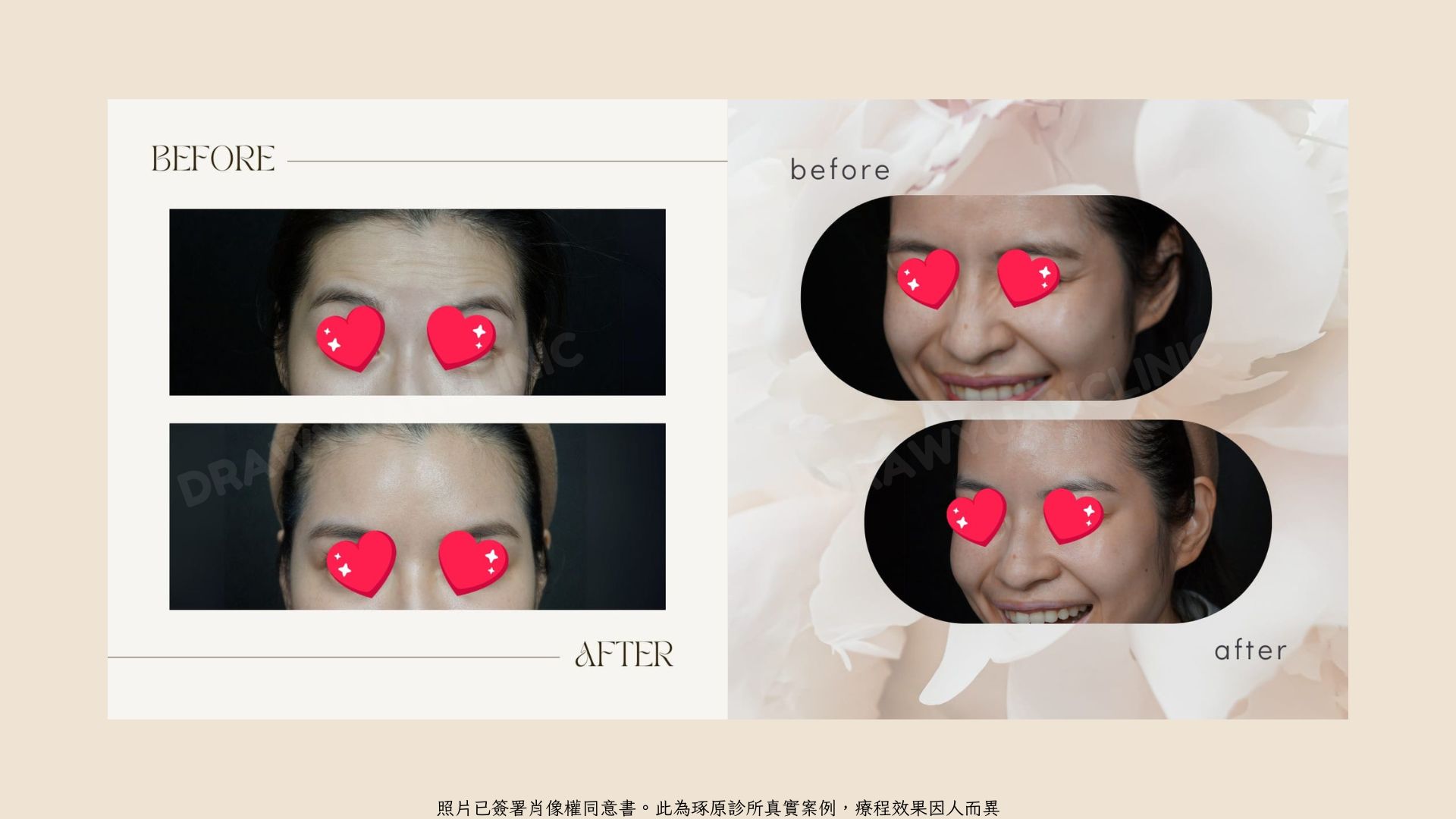 照片已簽署肖像權同意書。此為琢原診所真實案例，療程效果因人而異