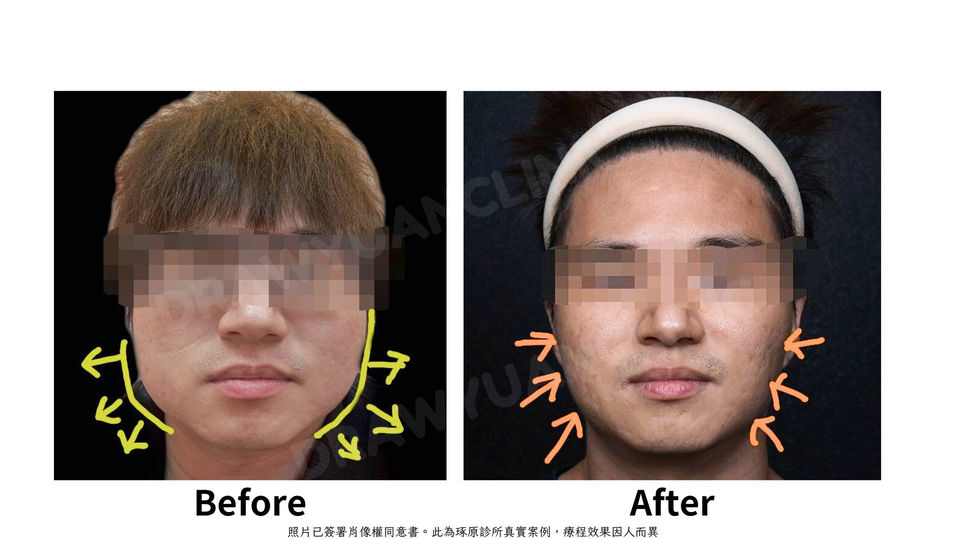 照片已簽署肖像權同意書。此為琢原診所真實案例，療程效果因人而異