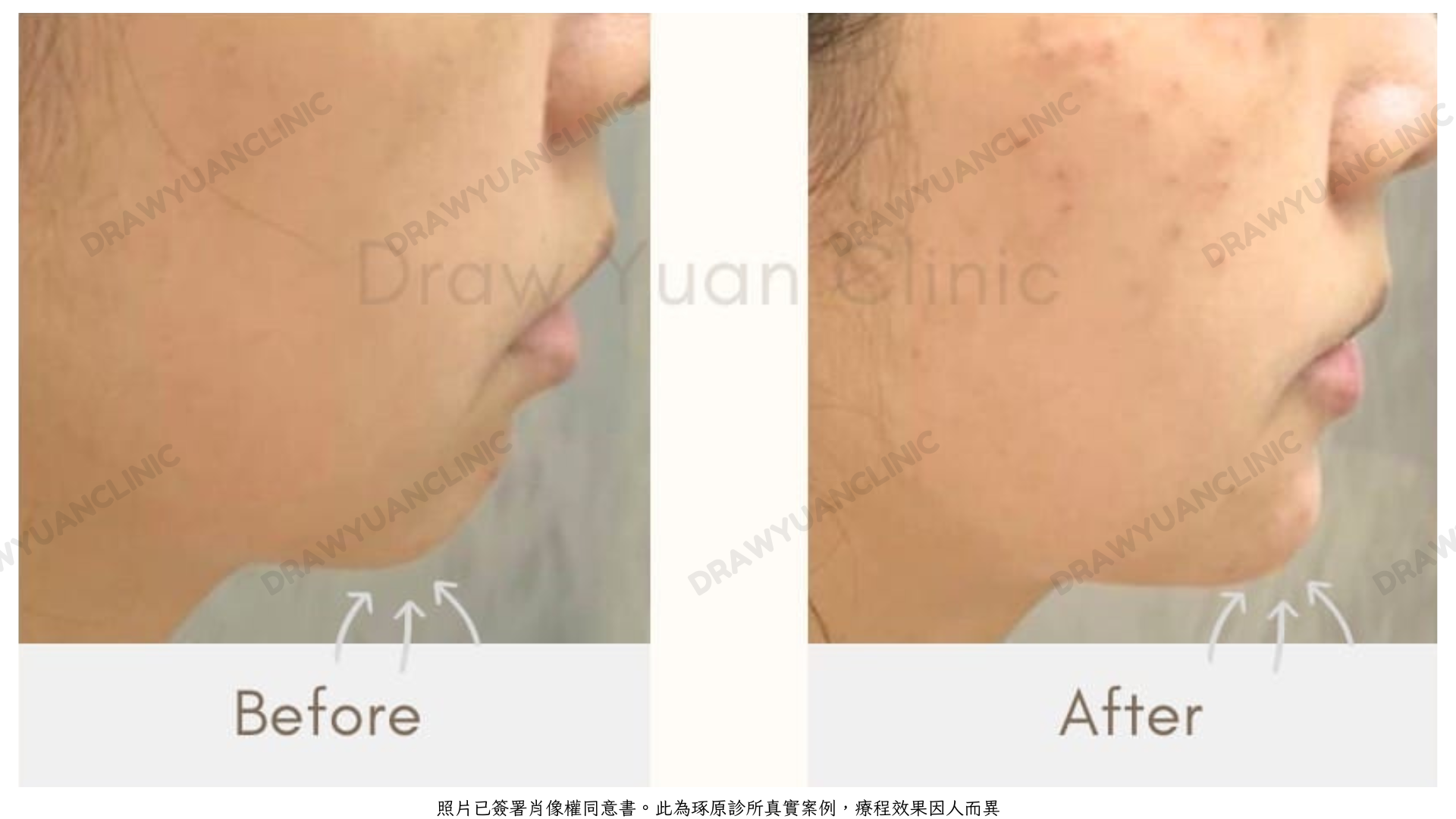 照片已簽署肖像權同意書。此為琢原診所真實案例,療程效果因人而異