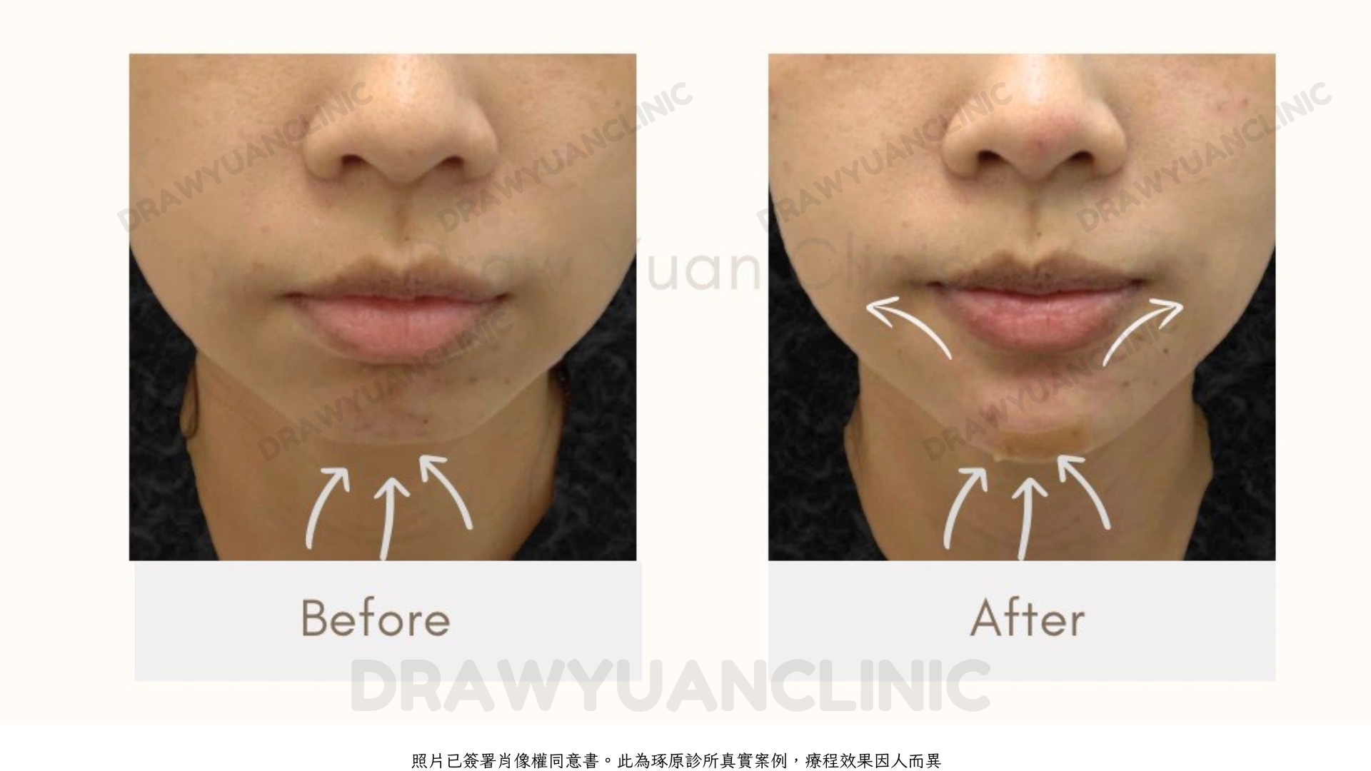 照片已簽署肖像權同意書。此為琢原診所真實案例,療程效果因人而異