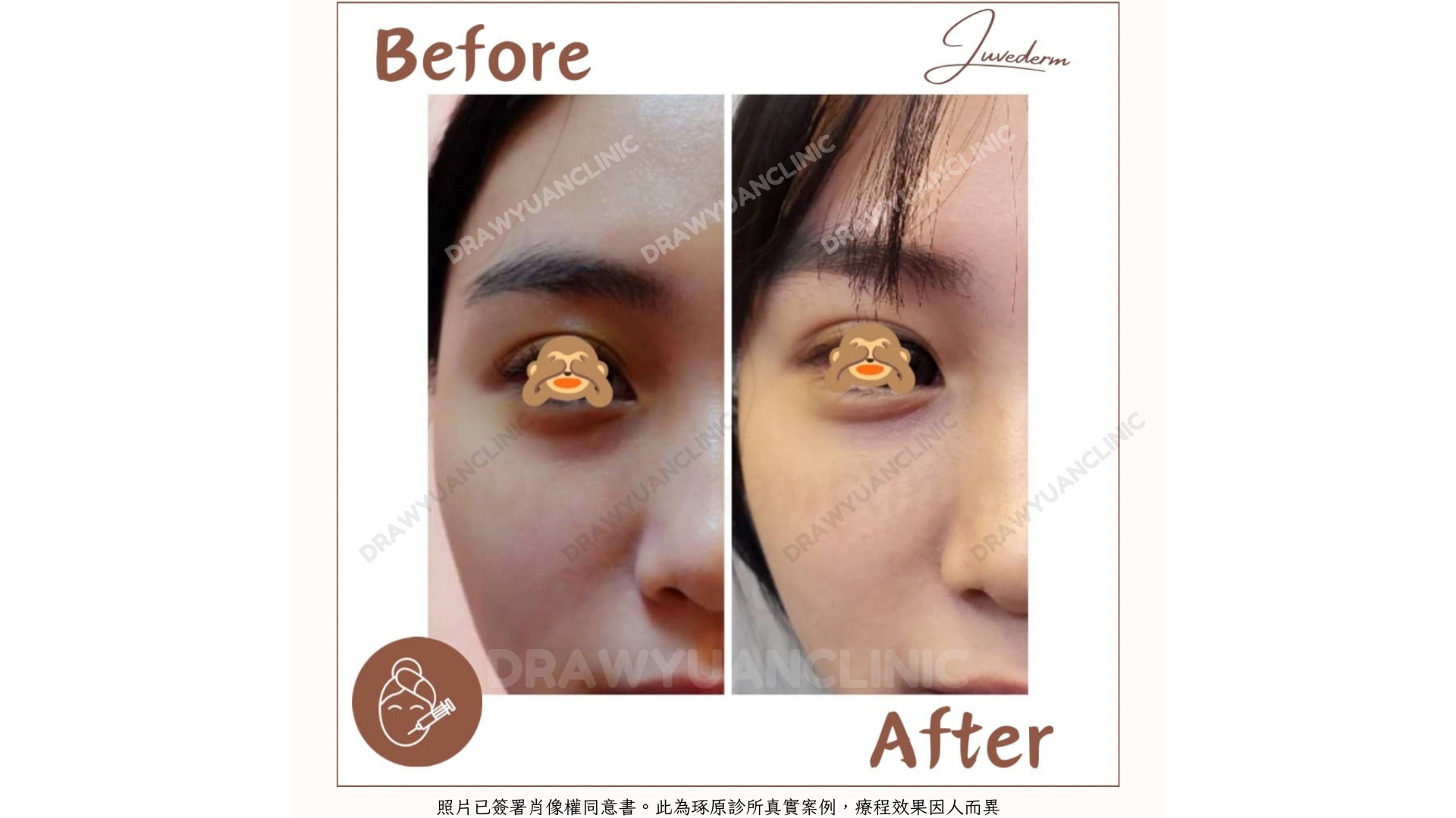 照片已簽署肖像權同意書。此為琢原診所真實案例,療程效果因人而異