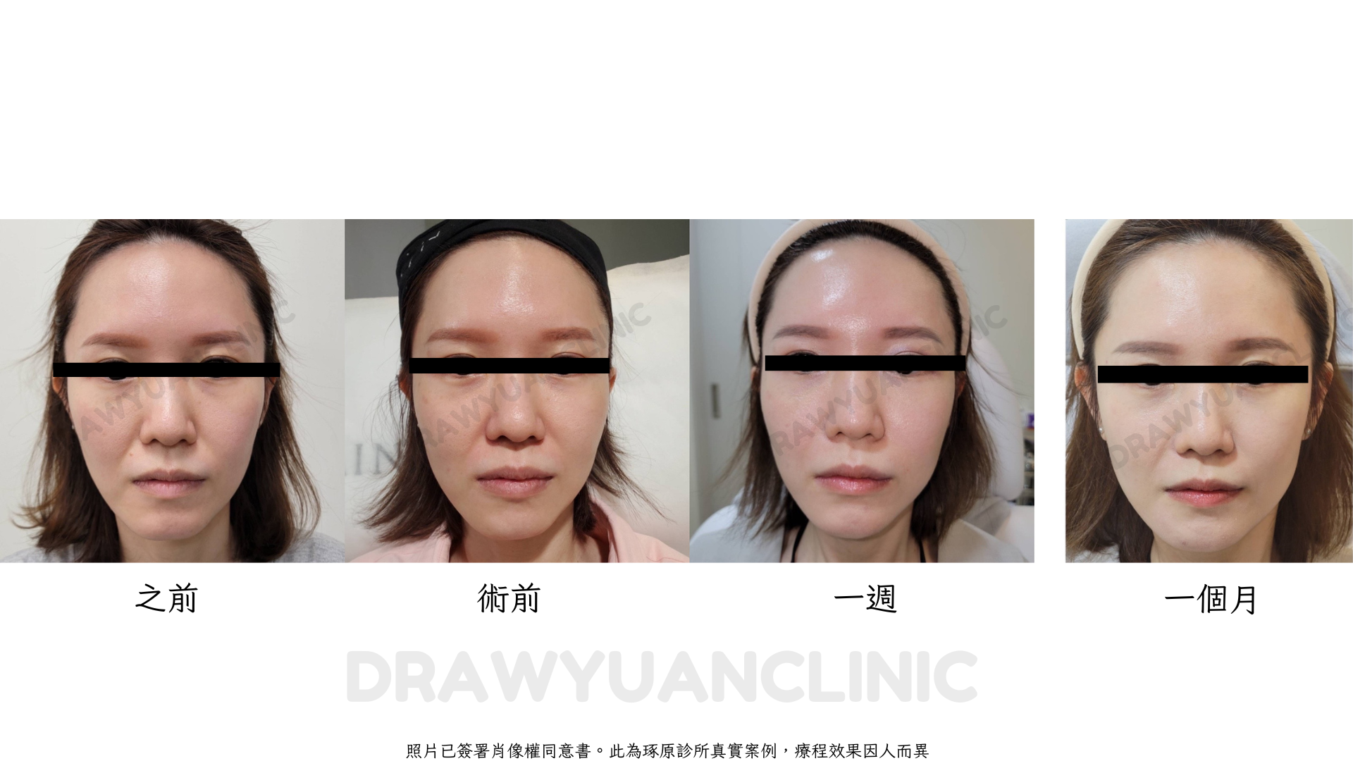照片已簽署肖像權同意書。此為琢原診所真實案例，療程效果因人而異
