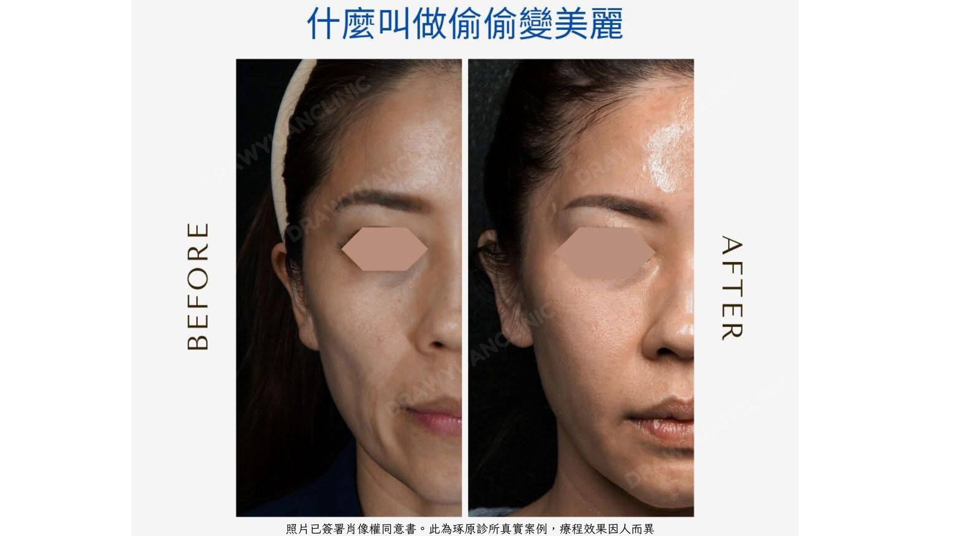 照片已簽署肖像權同意書。此為琢原診所真實案例，療程效果因人而異