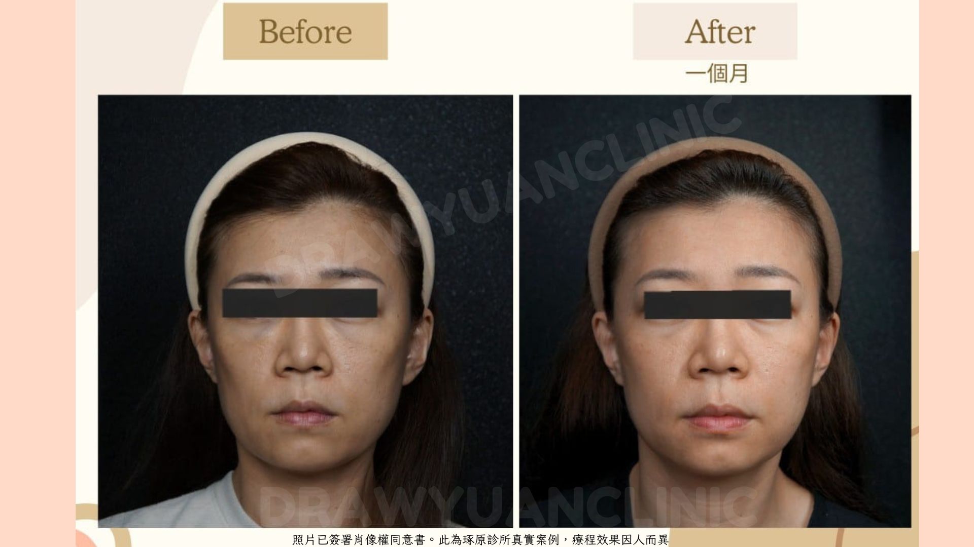 照片已簽署肖像權同意書。此為琢原診所真實案例，療程效果因人而異