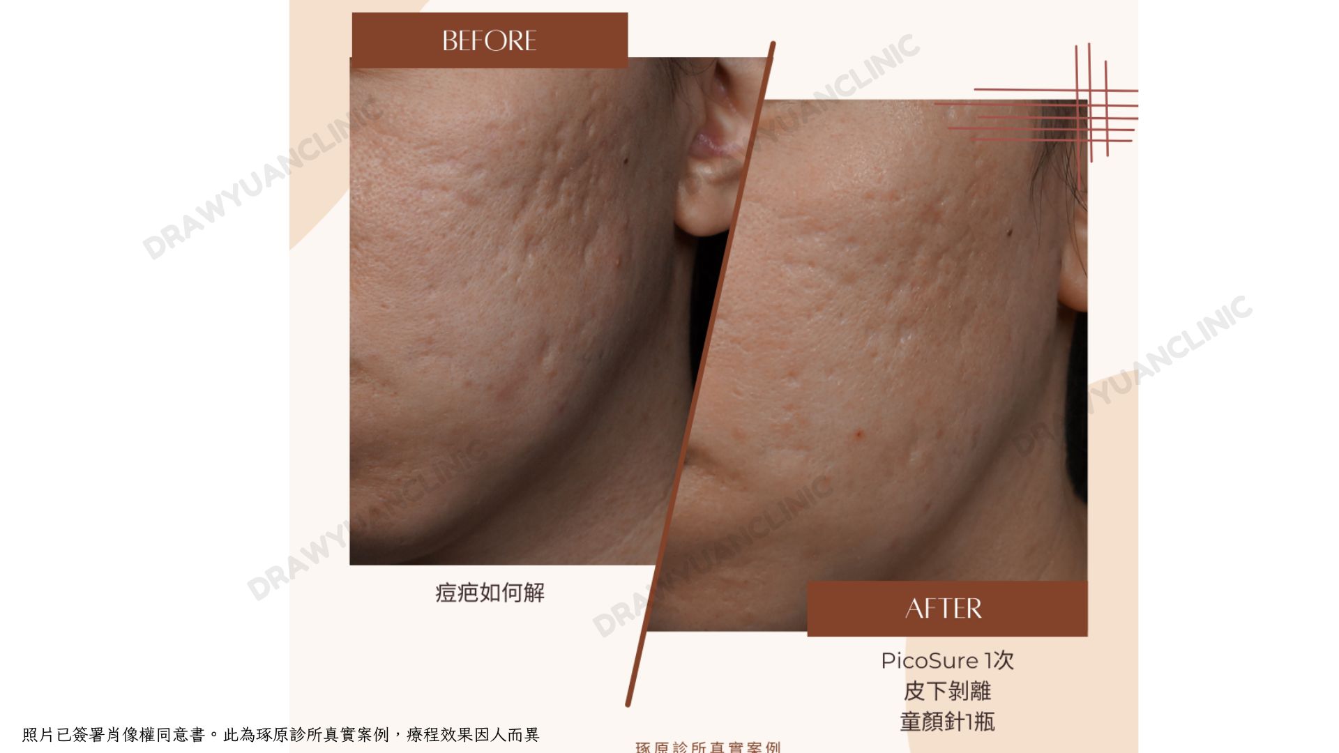 照片已簽署肖像權同意書。此為琢原診所真實案例，療程效果因人而異
