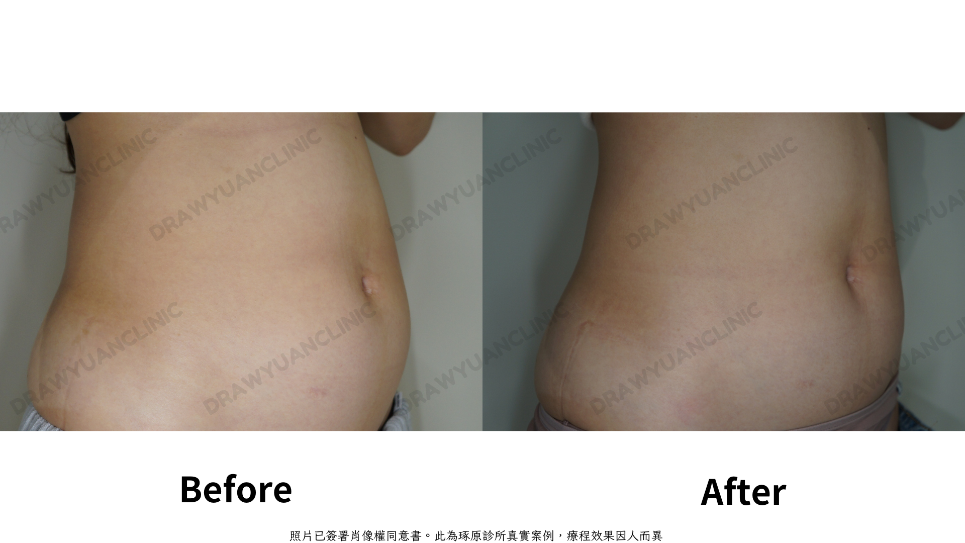 照片已簽署肖像權同意書。此為琢原診所真實案例，療程效果因人而異