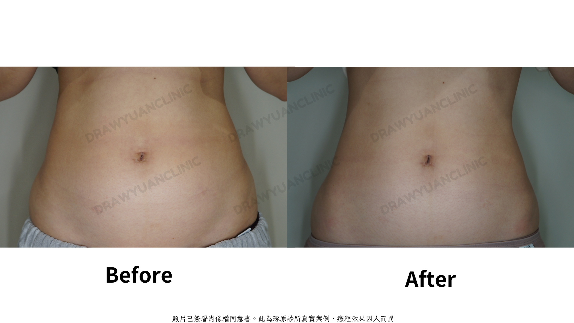 照片已簽署肖像權同意書。此為琢原診所真實案例，療程效果因人而異