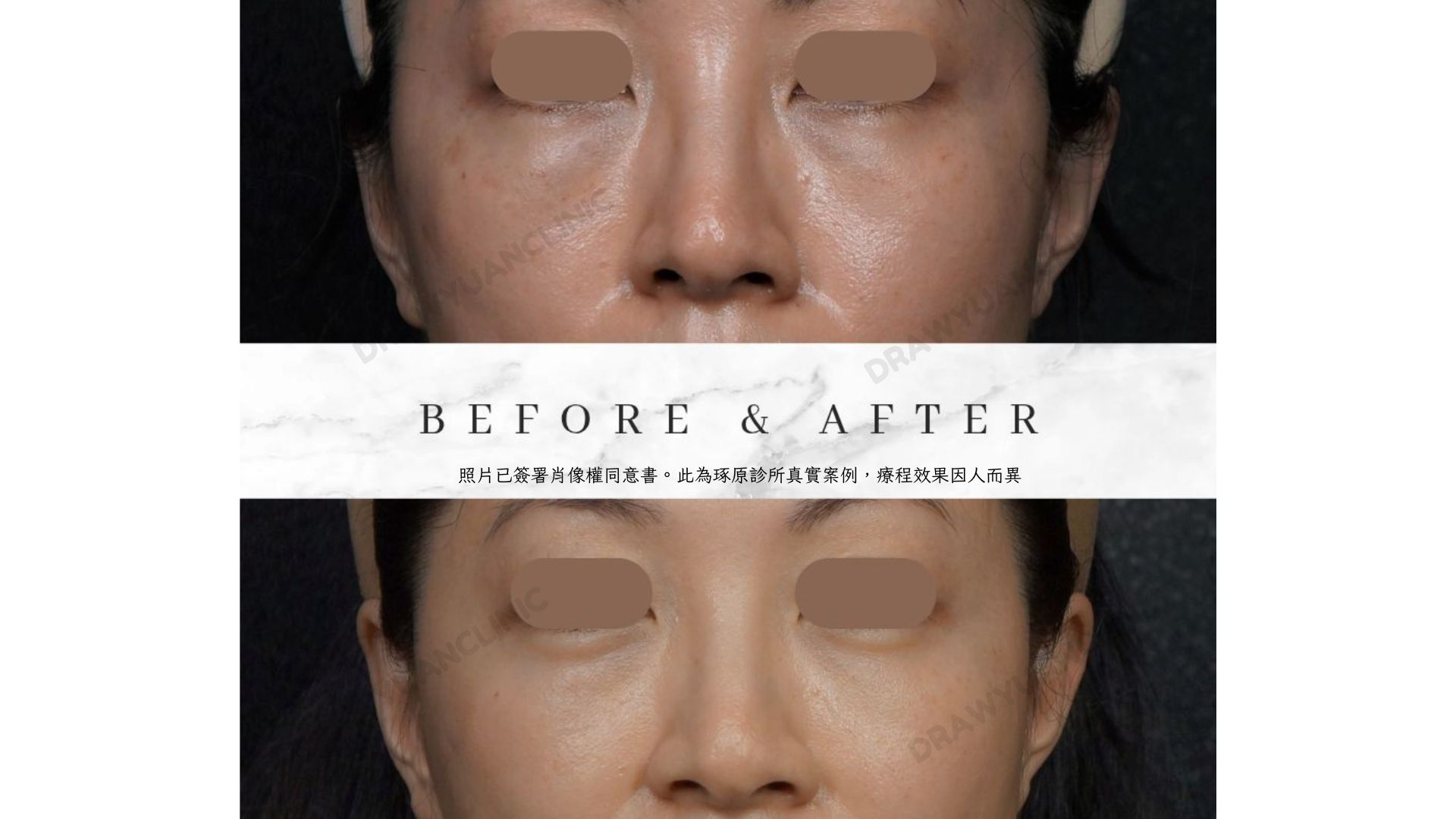 別院所施打過多玻尿酸,至本院降解後效果