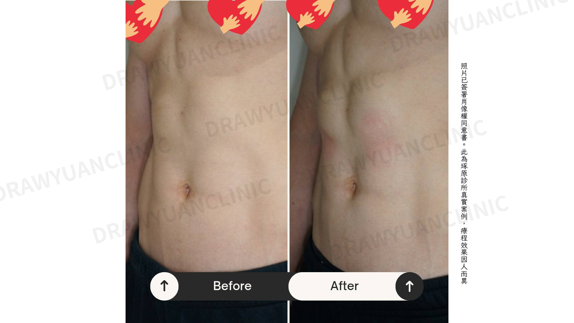 照片已簽署肖像權同意書。此為琢原診所真實案例，療程效果因人而異