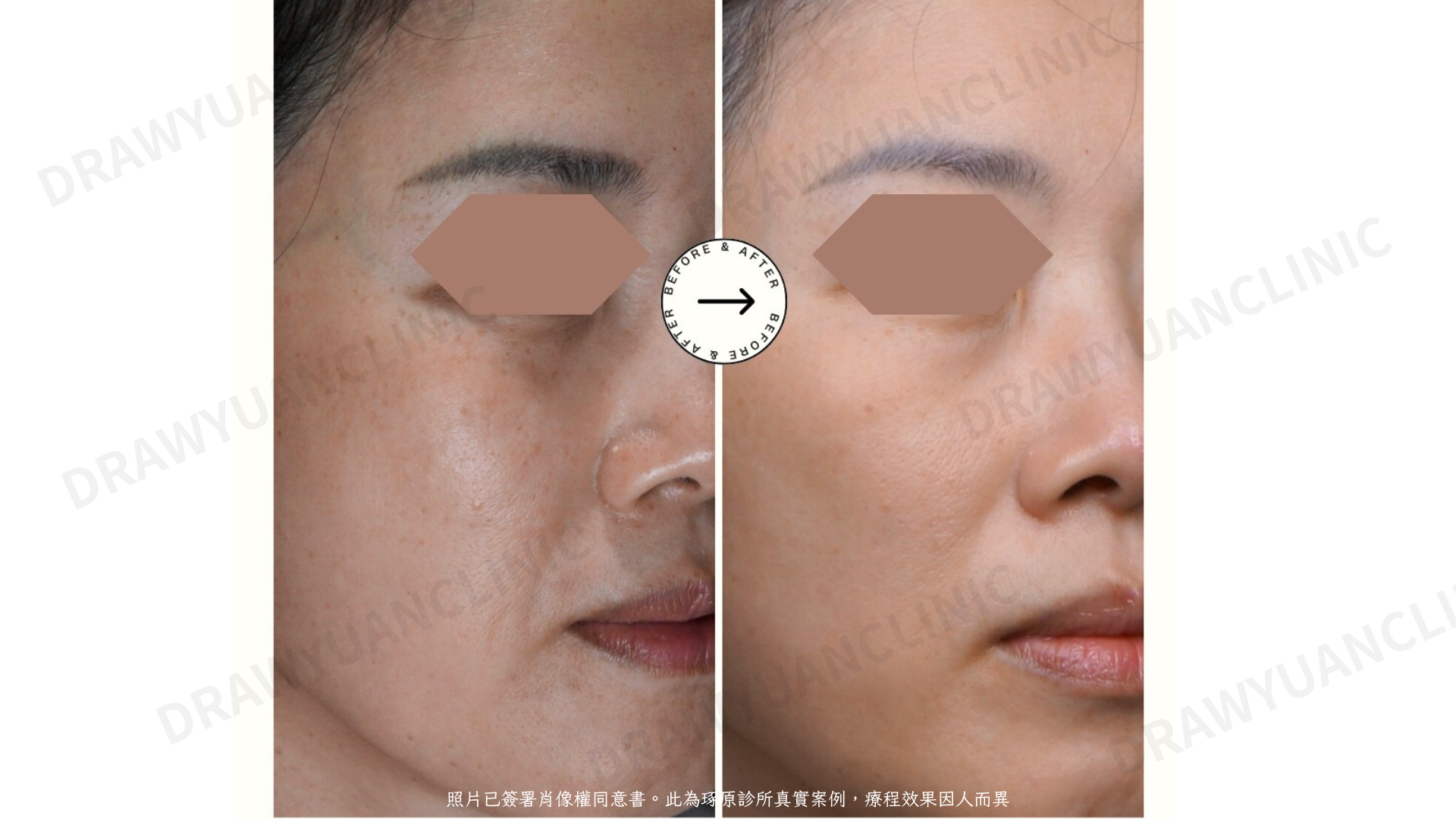 照片已簽署肖像權同意書。此為琢原診所真實案例,療程效果因人而異
