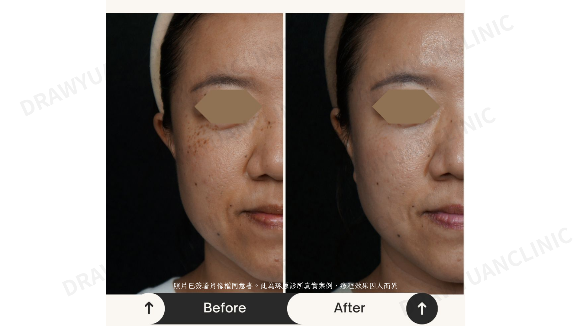 照片已簽署肖像權同意書。此為琢原診所真實案例,療程效果因人而異