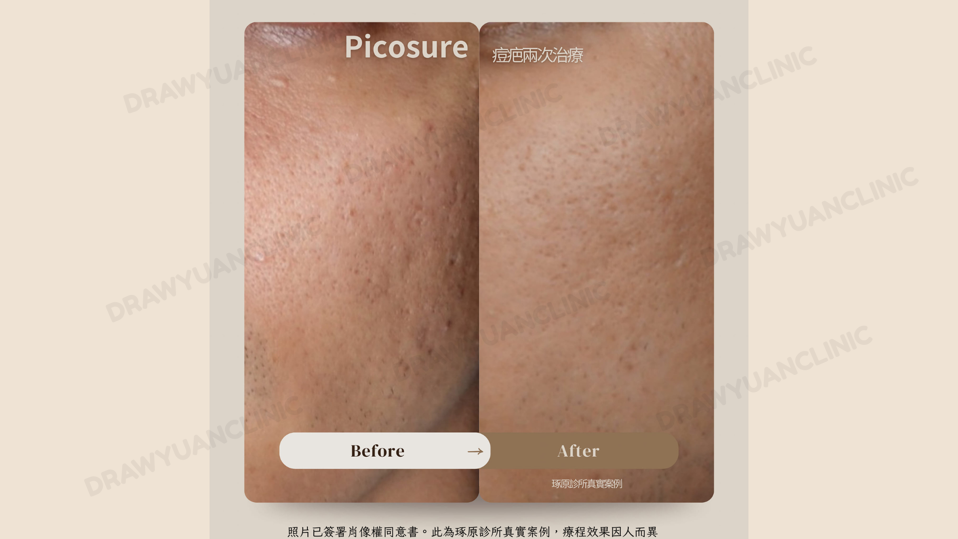 照片已簽署肖像權同意書。此為琢原診所真實案例,療程效果因人而異