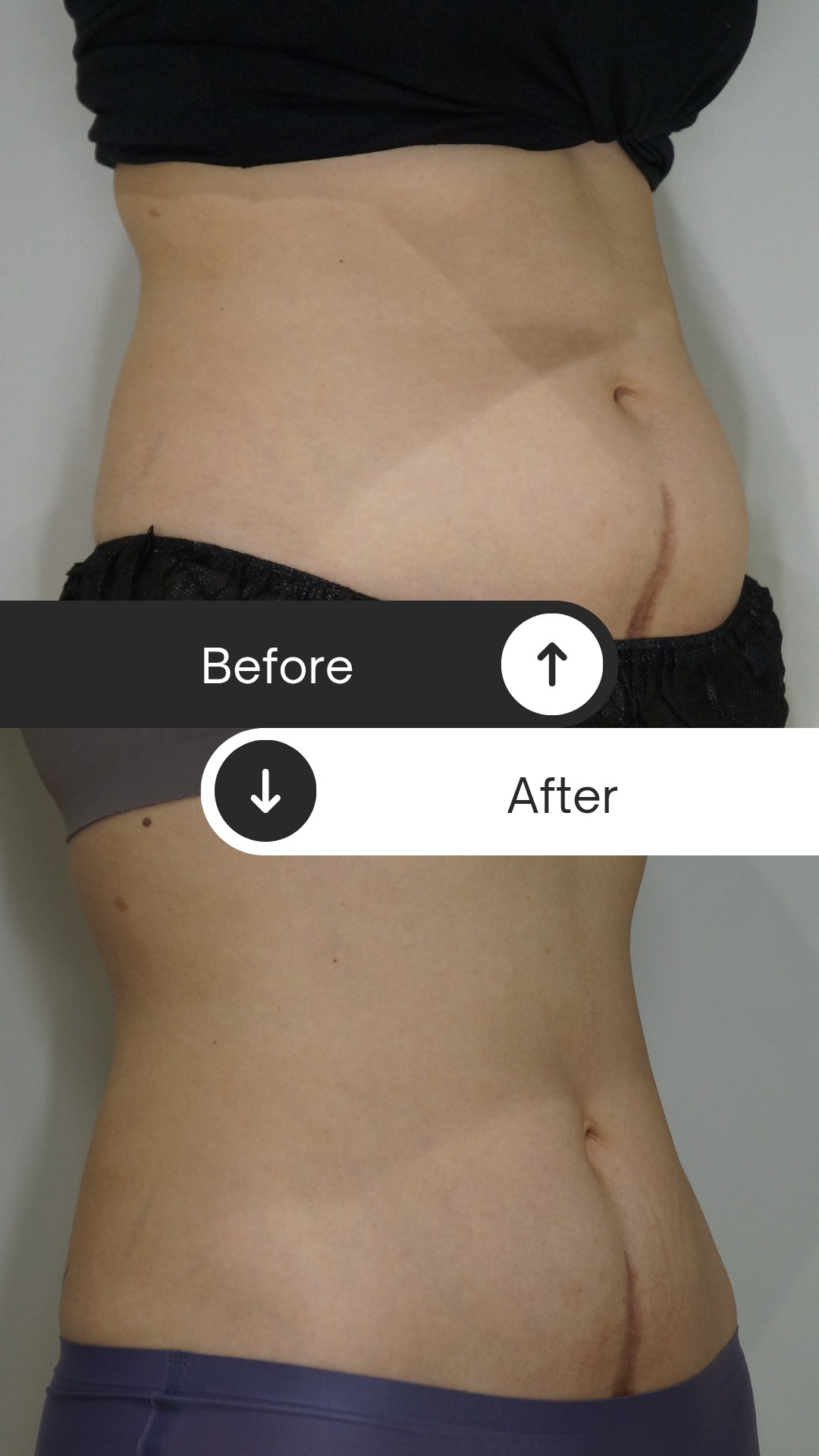 照片已簽署肖像權同意書。此為琢原診所真實案例,療程效果因人而異