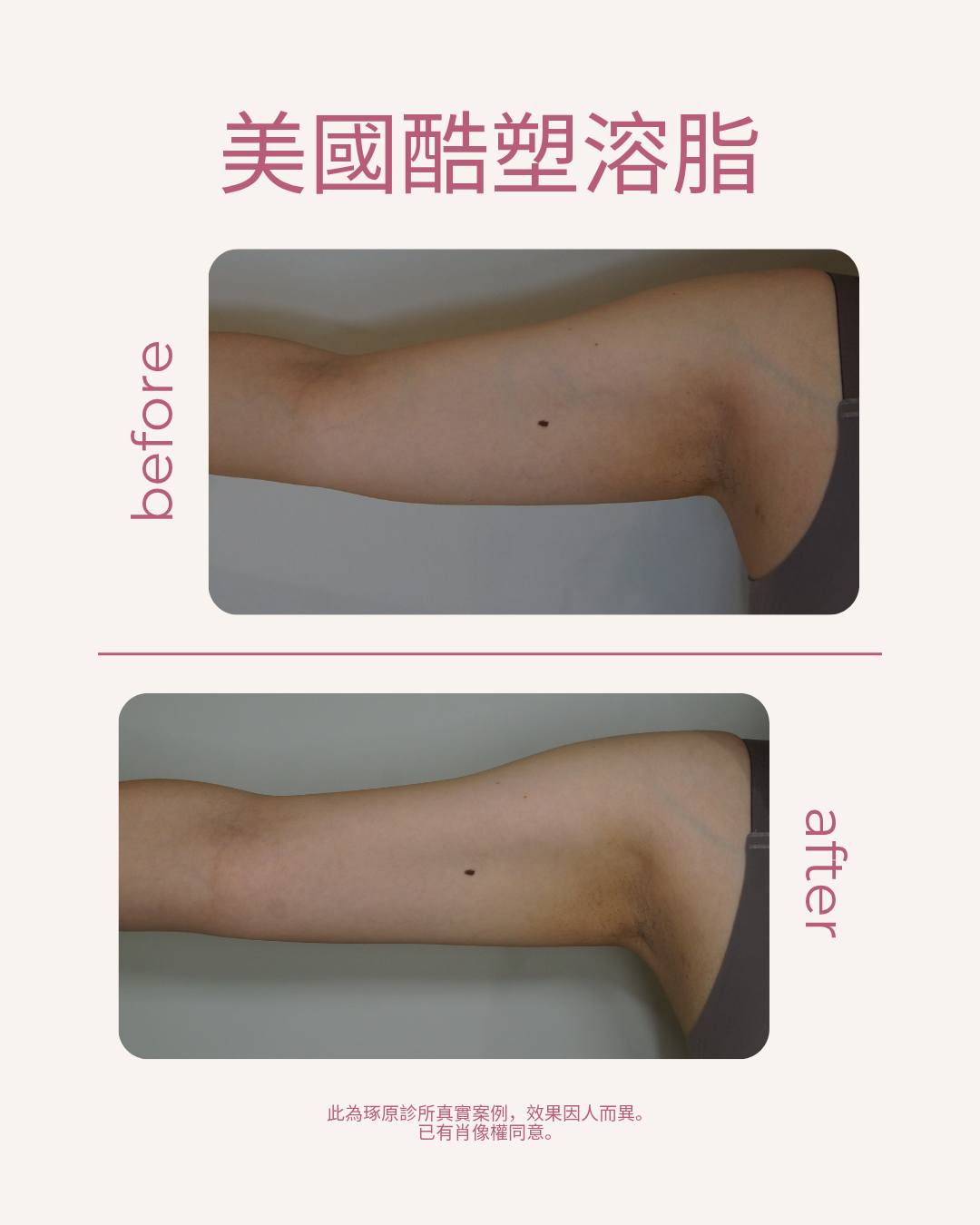 照片已簽署肖像權同意書。此為琢原診所真實案例,療程效果因人而異